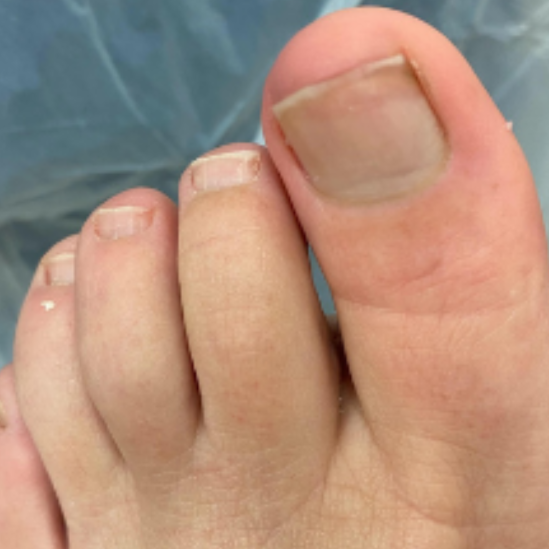 Toenail fungus treated with cold plasma — after