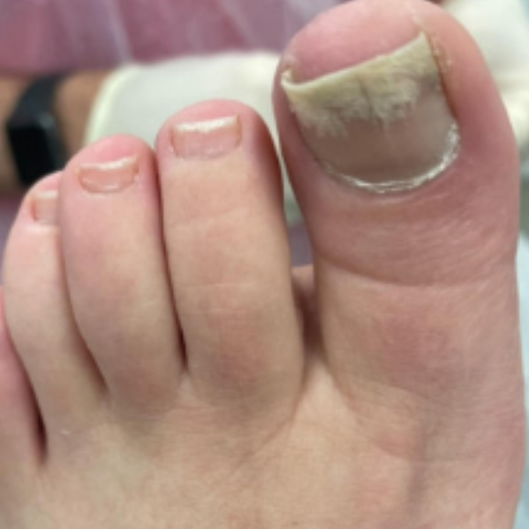 Toenail fungus treated with cold plasma — before
