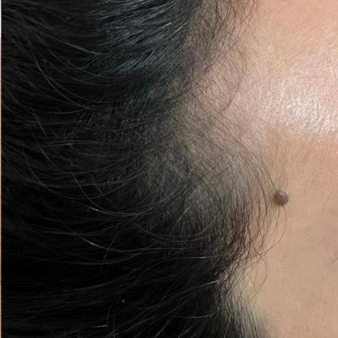 Hairline restoration along the temple — after