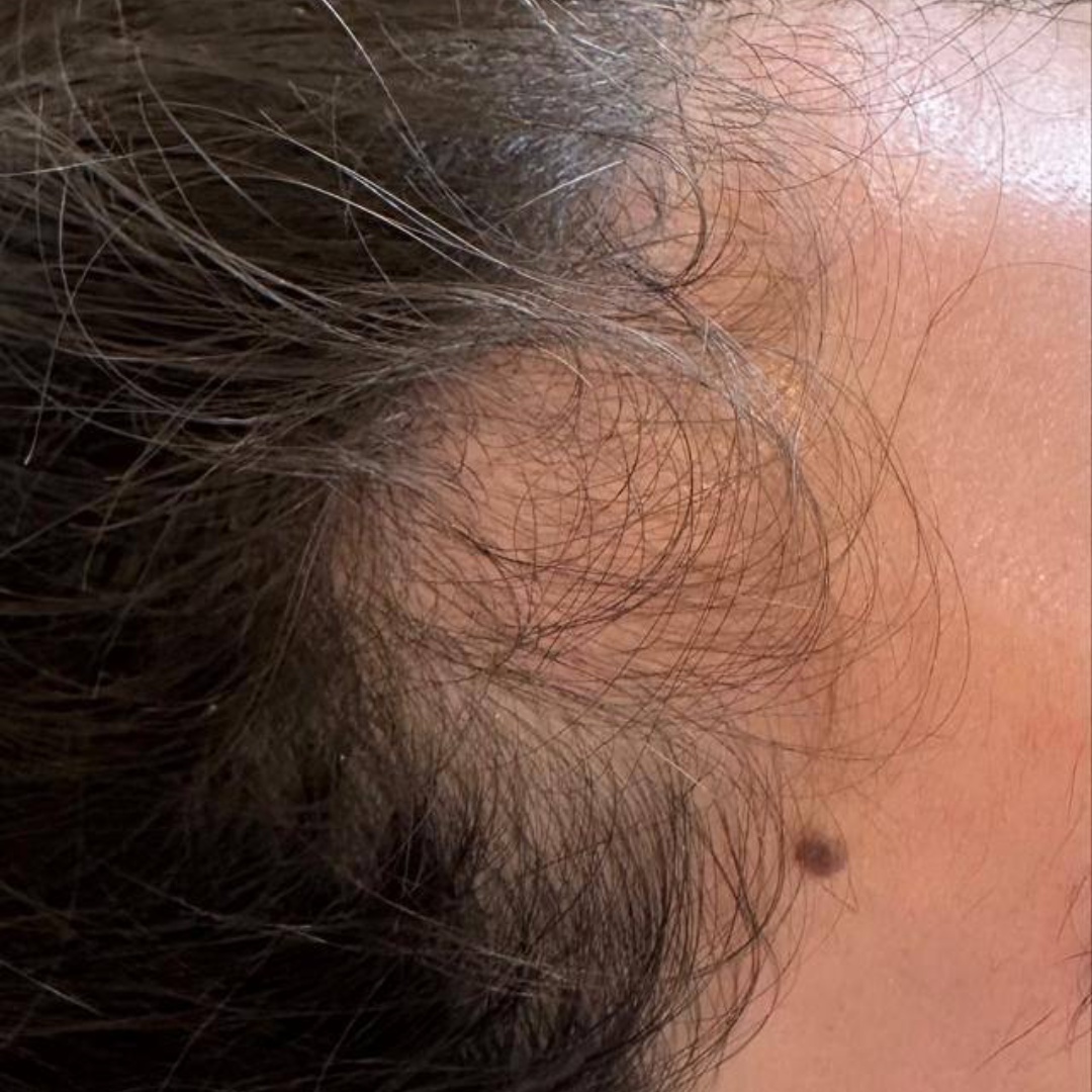 Hairline restoration along the temple — before