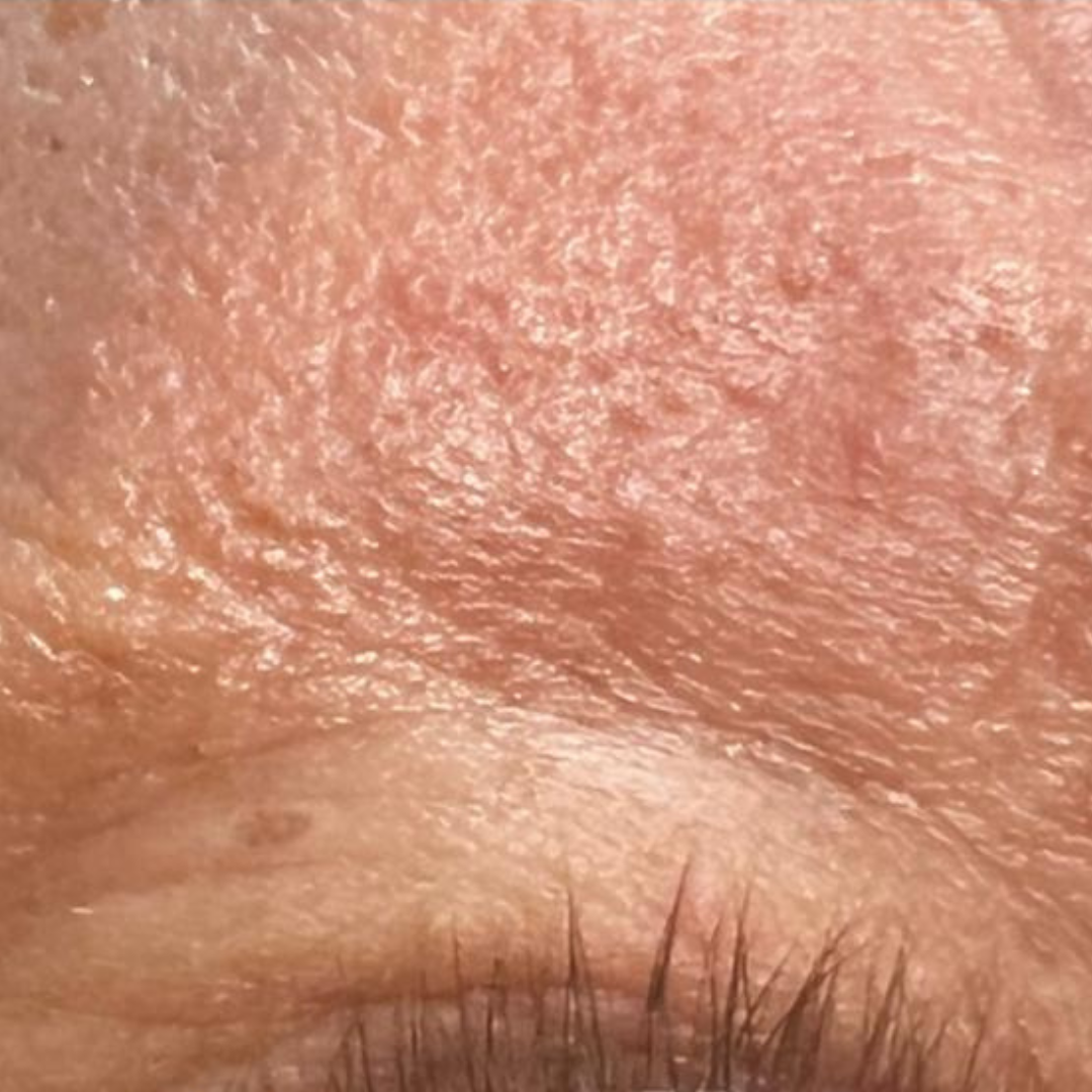 Skin lesion removal result — after