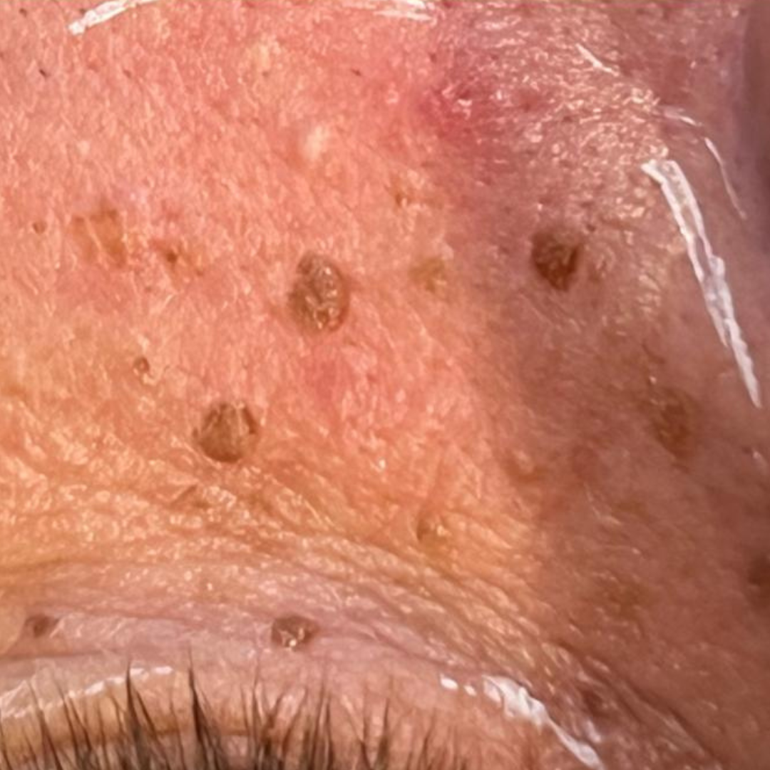 Skin lesion removal result — before