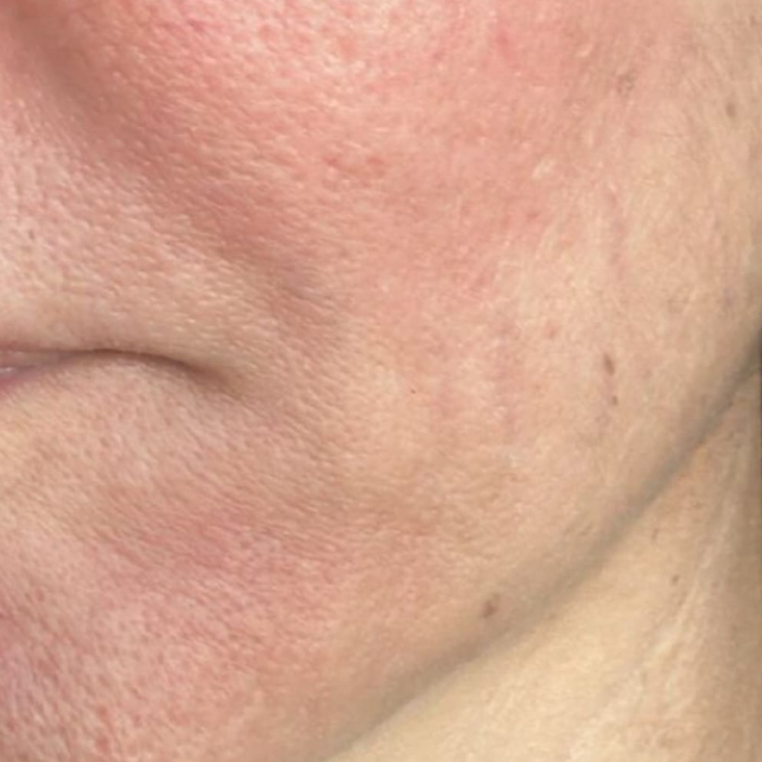 Scar revision on the skin — after
