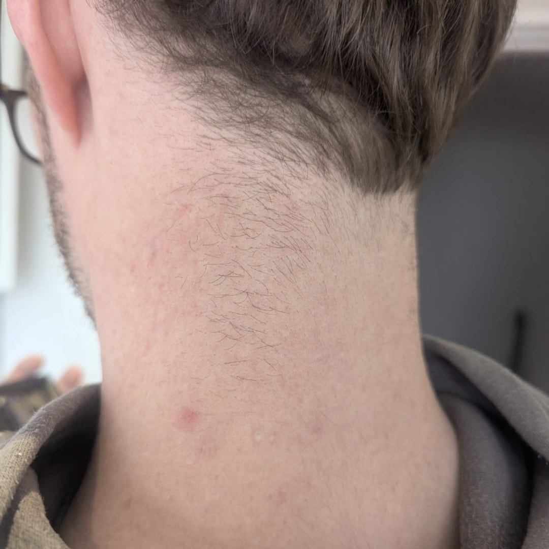 Acne scarring and texture refined by microneedling — after