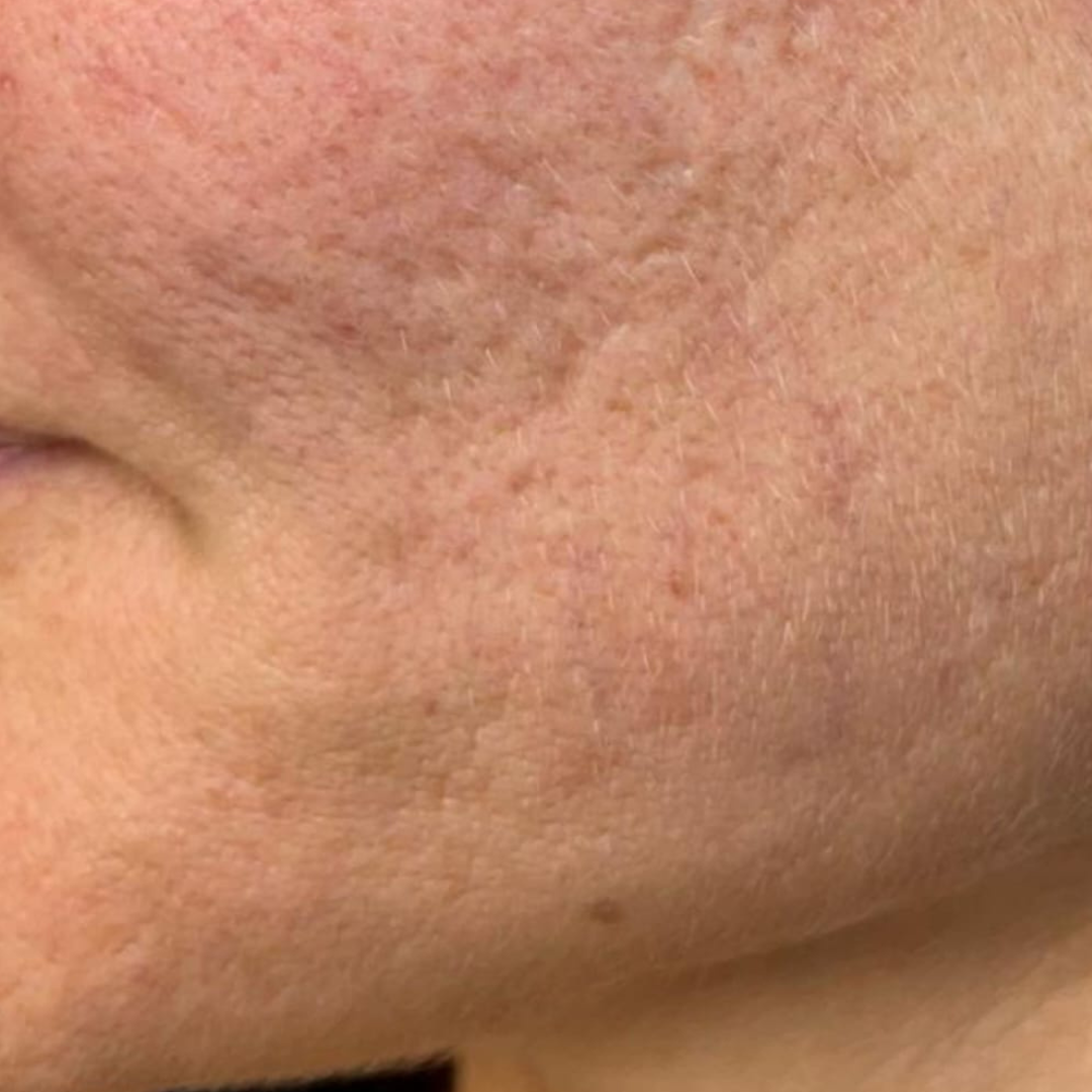Scar revision on the skin — before