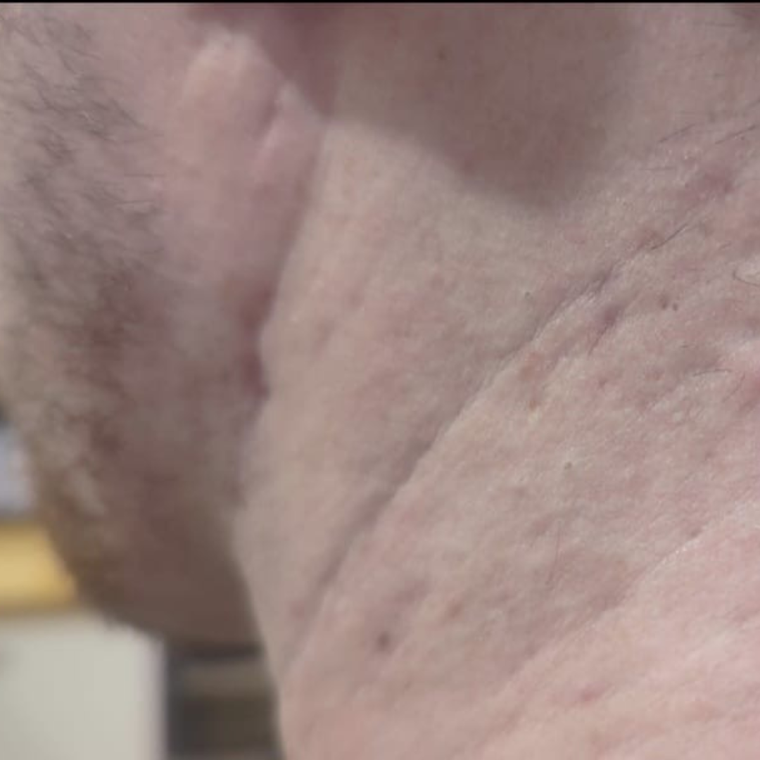 Acne scarring and texture refined by microneedling — before