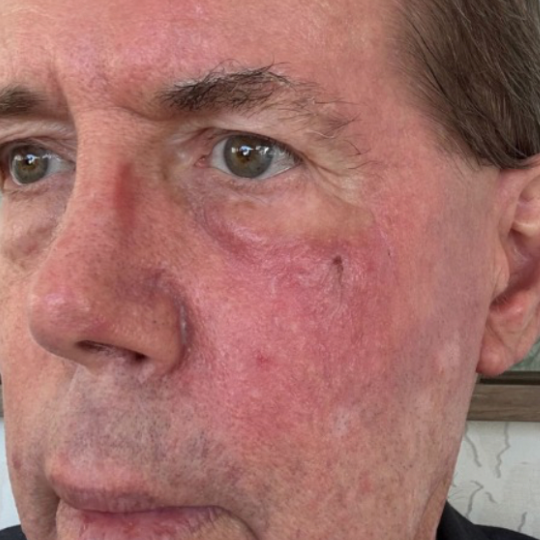 Facial redness and texture treated with cold plasma — after