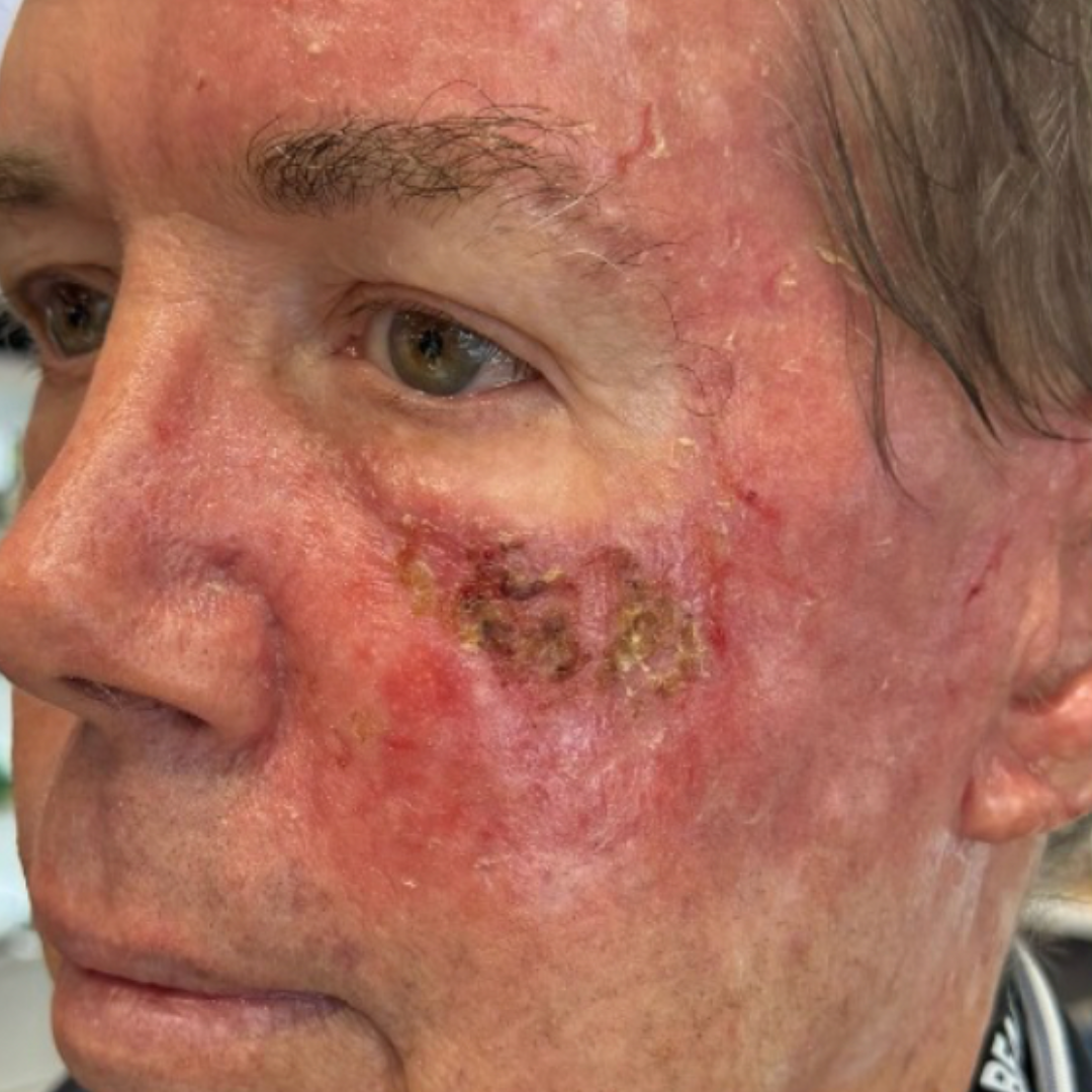 Facial redness and texture treated with cold plasma — before
