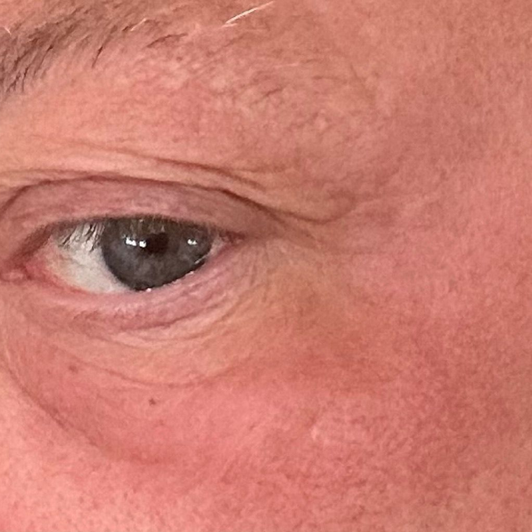 Skin tightening around the eye — after