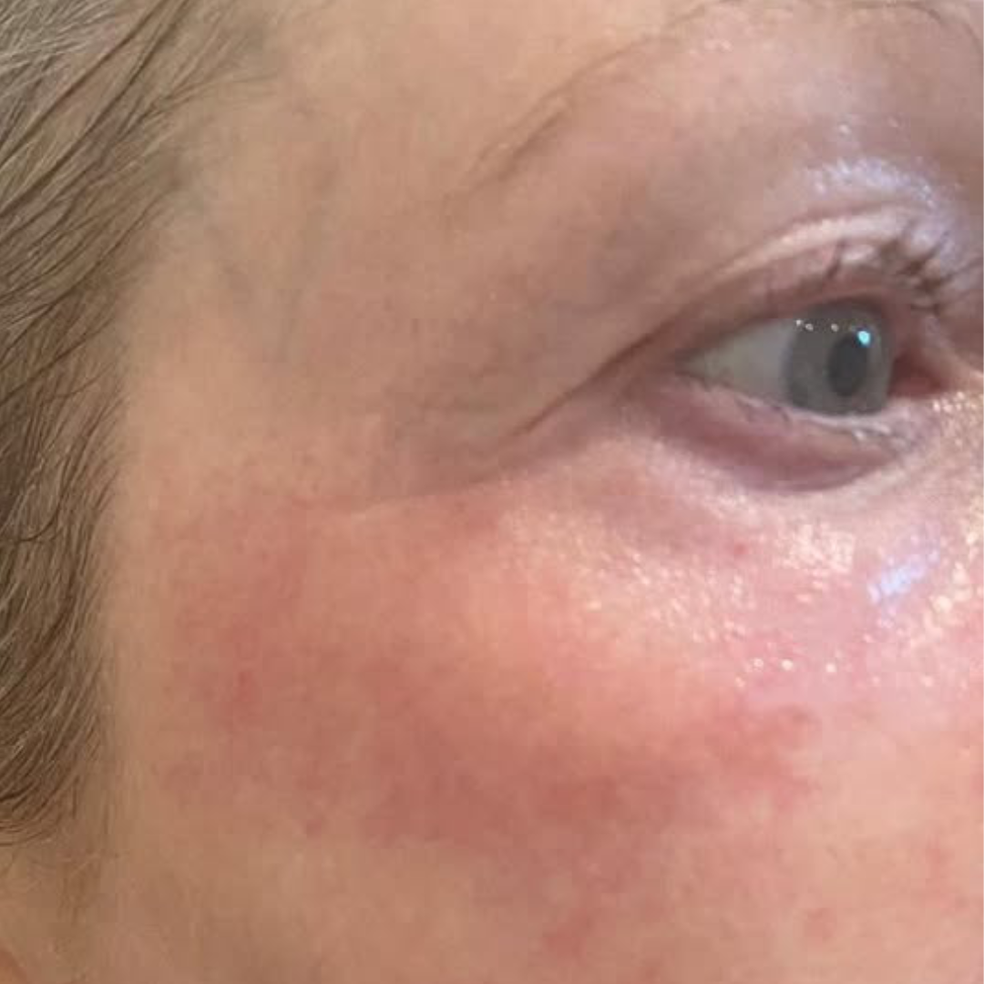 Skin resurfacing and tightening result — after