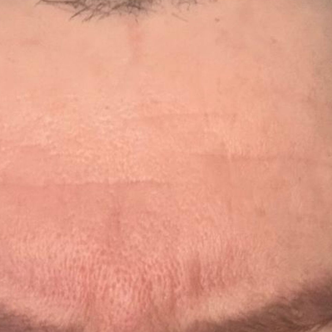 Deep resurfacing and tightening result — after
