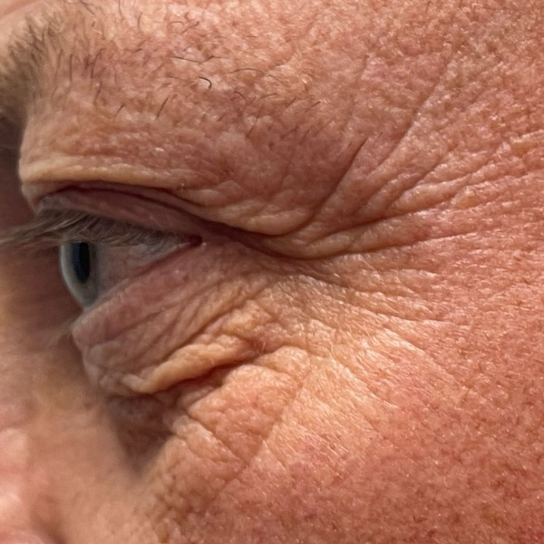 Skin tightening around the eye — before
