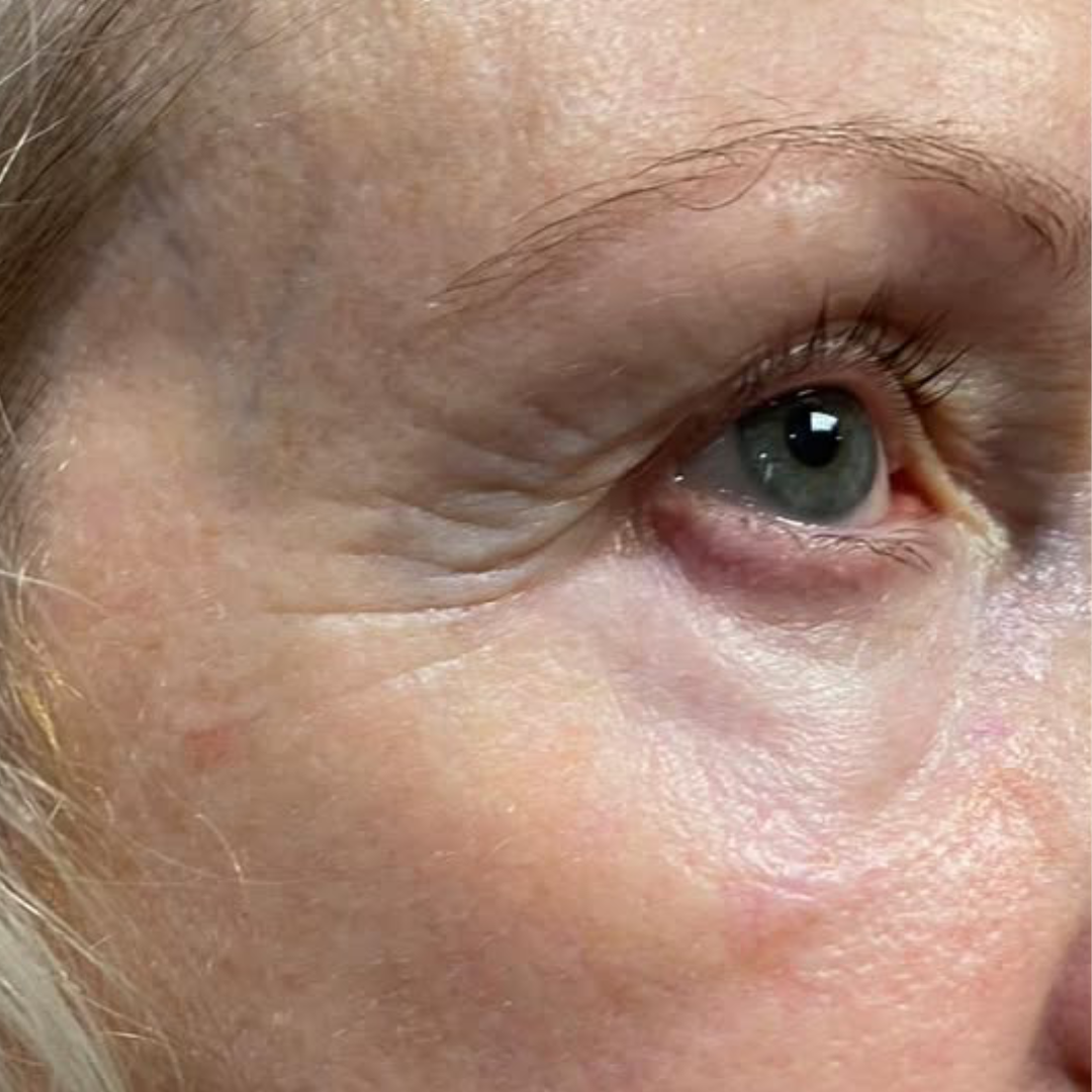 Skin resurfacing and tightening result — before