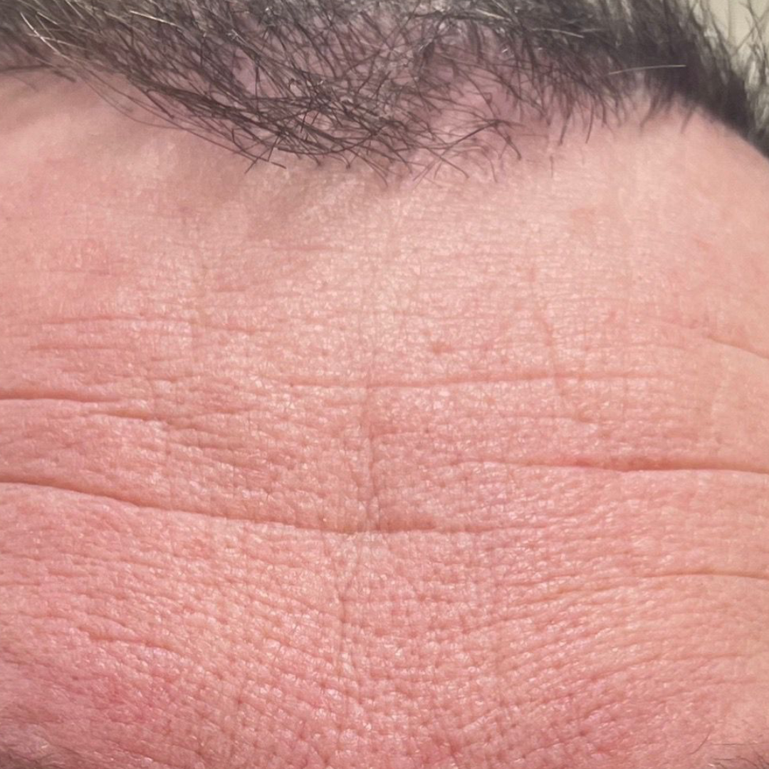 Deep resurfacing and tightening result — before
